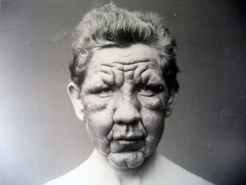 Leprosy Museum, Norway